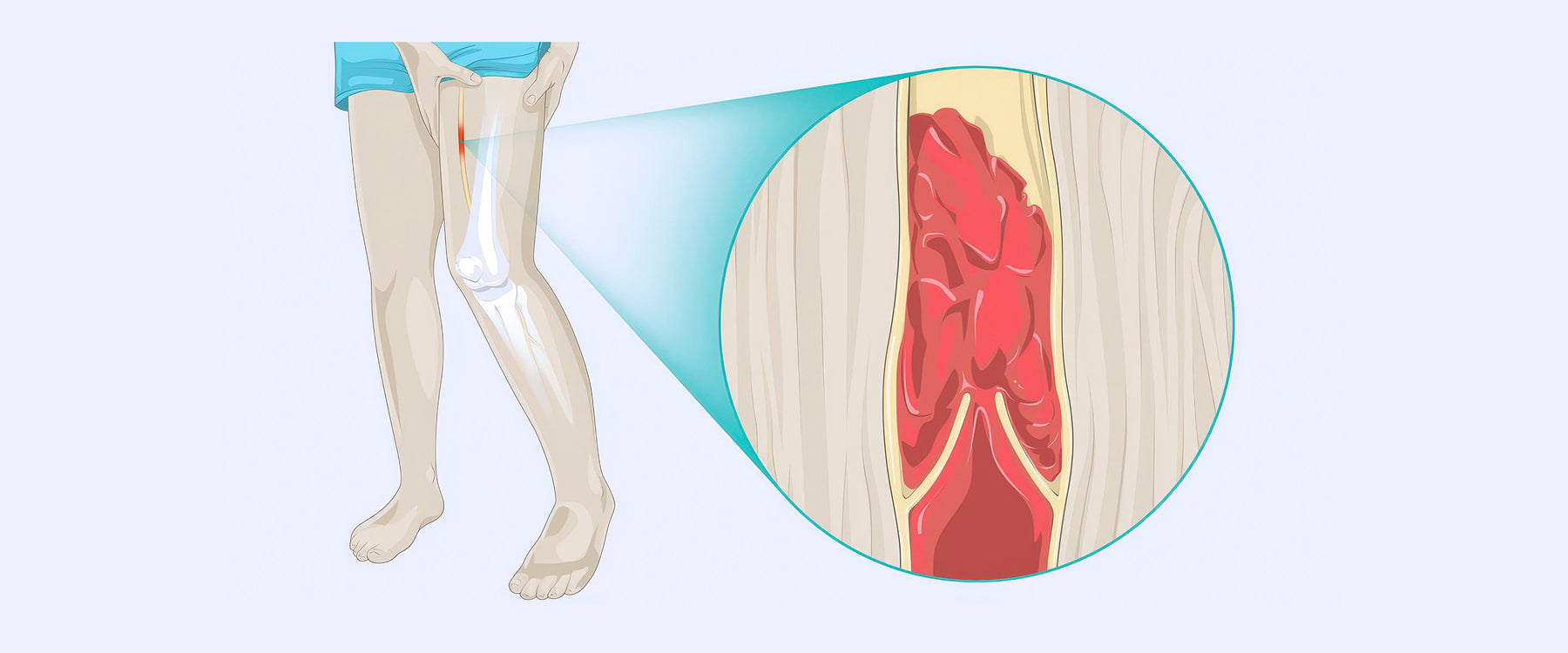 Dvt Stevenage DVT (Deep Vein Thrombosis) – The Complete Injury Guide — Vive Health