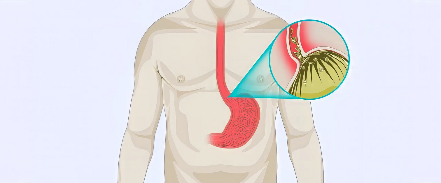 GERD - The Complete Guide — Vive Health