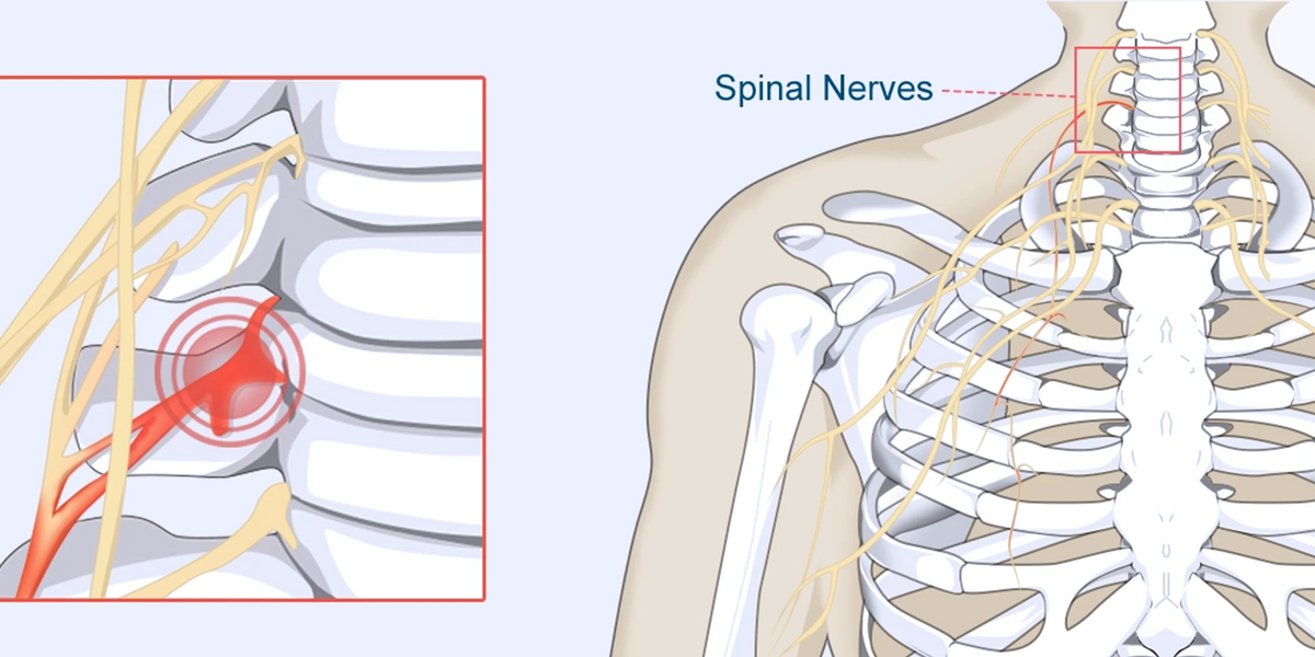 Pinched Nerve – The Complete Injury Guide — Vive Health