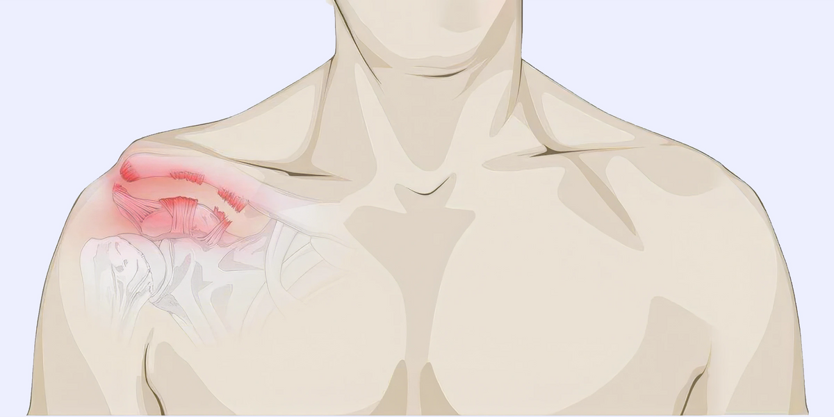How to Prevent AC Joint Injury: Expert Tips