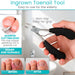 Ingrown Toenail Tool